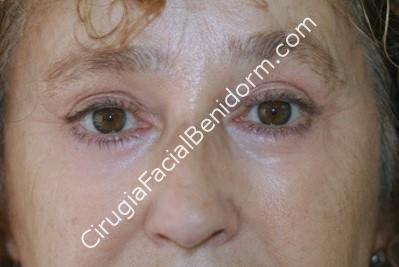 Blefaroplastia inferior para las bolsas de los ojos. blepharoplasty for the reduction of the bags under the eyes. Before and after.