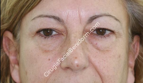 Blefaroplastia inferior para las bolsas de los ojos. blepharoplasty for the reduction of the bags under the eyes. Before and after.