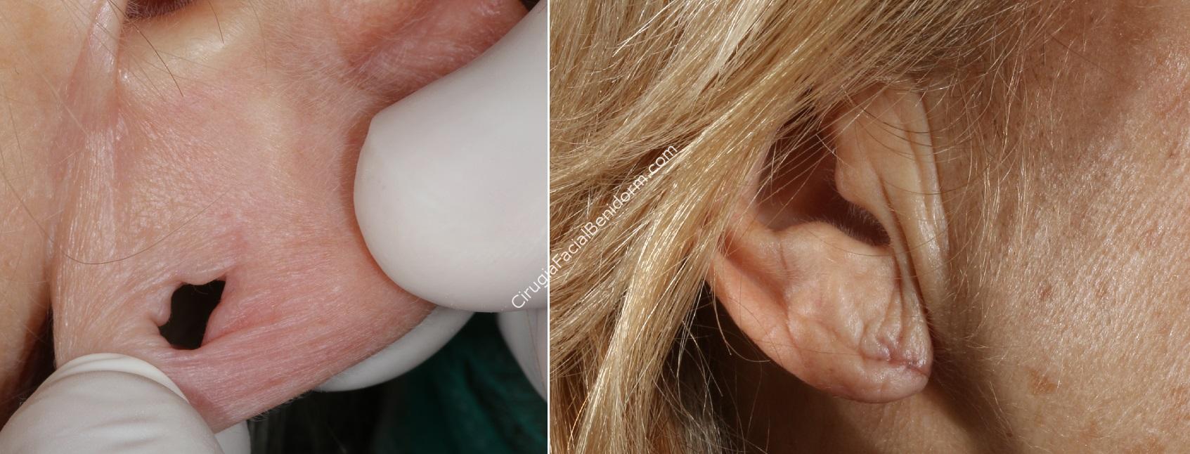 Es posible cerrar el agujero del lóbulo de la oreja con cirugía?