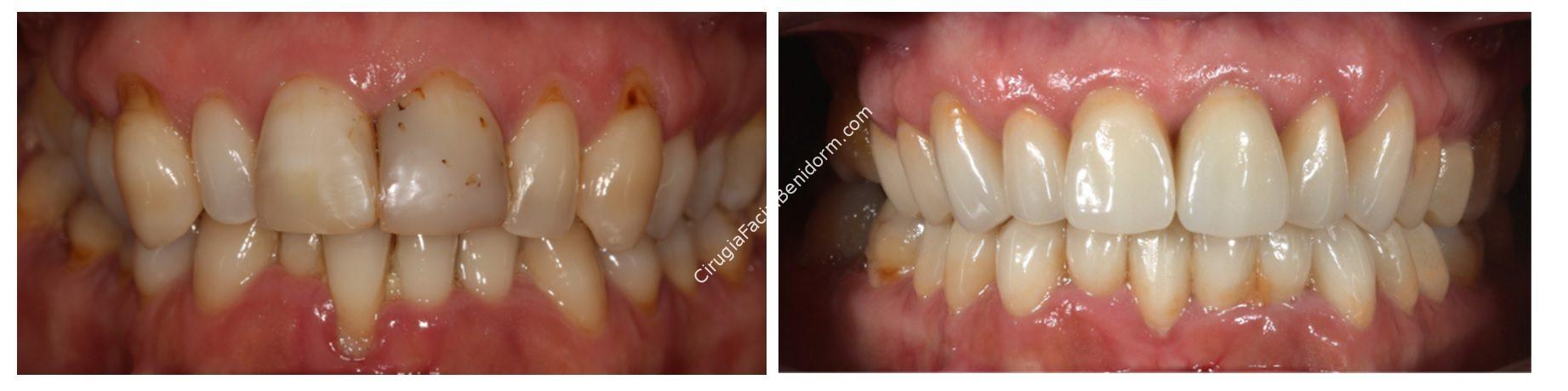Estética Dental Paciente Tipo III
