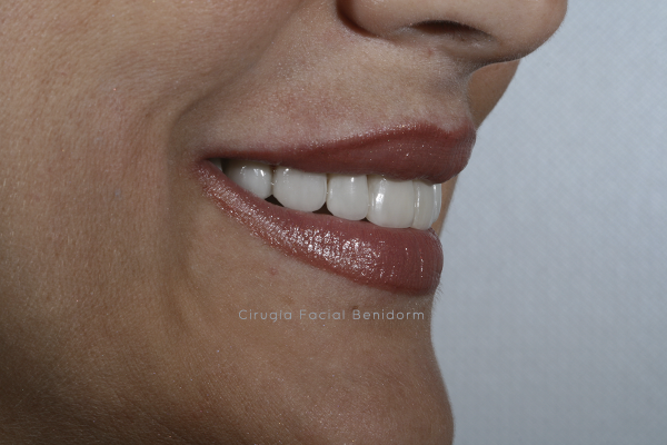 Carillas estéticas dental Benidorm. Veneers in Spain