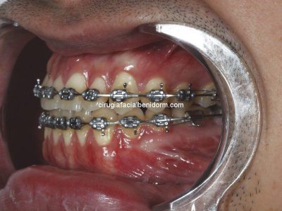 Cirugía maxilofacial para retrasar la mandíbula, Benidorm, España