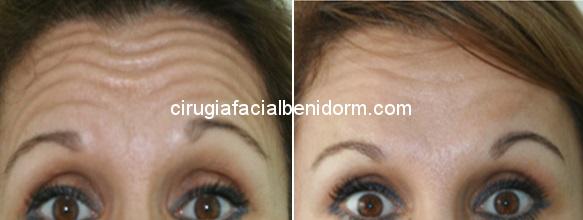 botox y mesobotox before and after Botox antes y después en Alicante