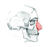 En la rinoplastia conservadora el bloque de la nariz queda intacto